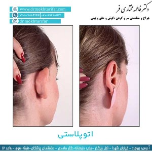 اتوپلاستی در لرستان 