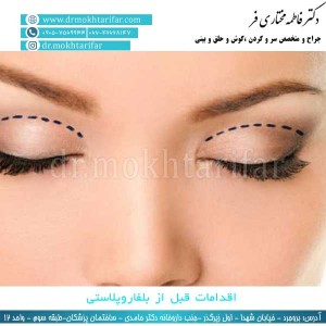 اقدامات قبل از بلفاروپلاستی