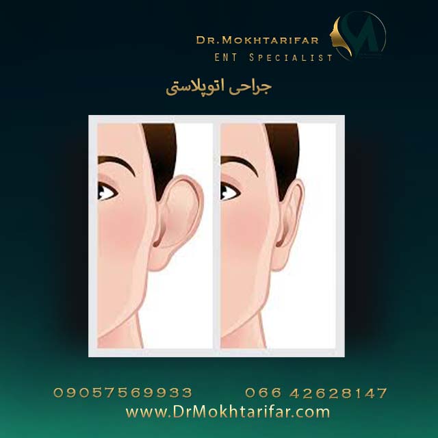جراحی اتوپلاستی 