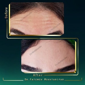 از بین بردن خط پیشانی