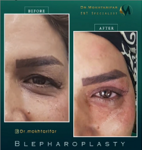 نمونه کار جراحی پلک توسط دکتر فاطمه مختاری فر