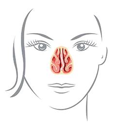 نحوه انجام عمل جراحی انحراف بینی چگونه است؟