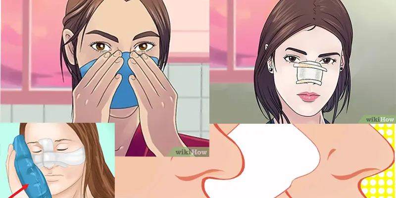 کاهش تورم بعد از عمل بینی