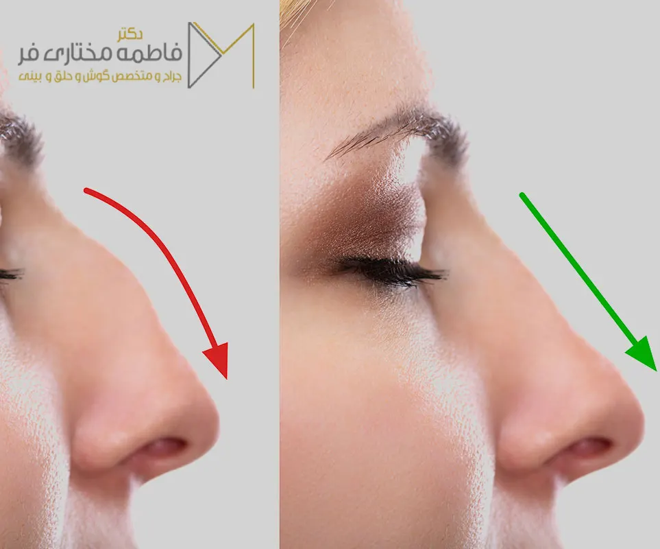 عمل قوز بینی